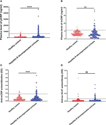 Monomeric C-reactive protein is associated with severity and prognosis of decompensated hepatitis B cirrhosis